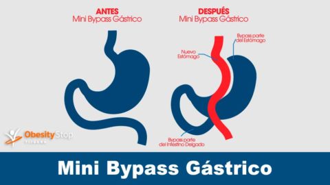 Mini Bypass Gástrico Todo sobre Cirugía de mini bypass gastrico