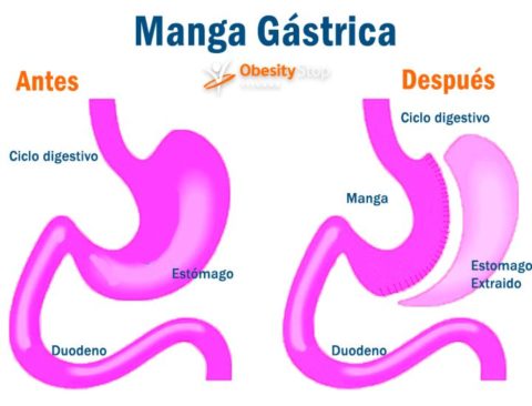 Manga G Strica Pros Y Contras Que Es S Ntomas Y Tratamiento