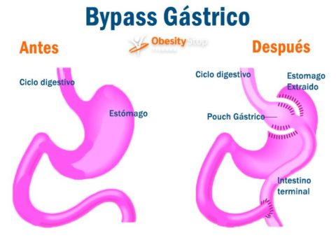 BYPASS GÁSTRICO: PROS Y CONTRAS ¿Qué Es Y En Que Consiste?